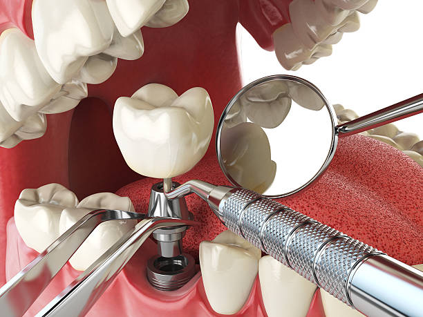 Best Emergency Dental Care for Abscessed Tooth in Crooksville, OH